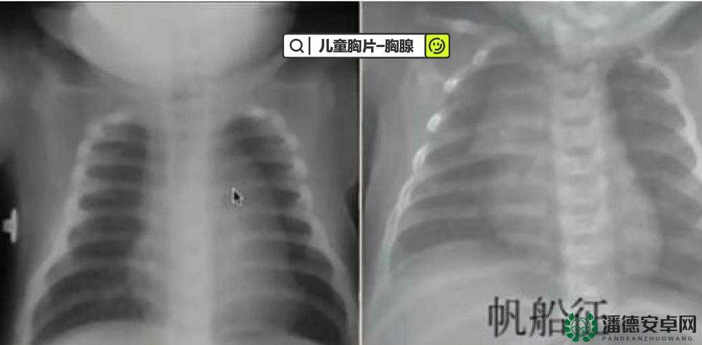 十大曝光胸片：揭示医疗影像背后的隐秘与真相